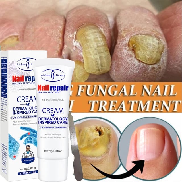 crema anti-hongos para uñas